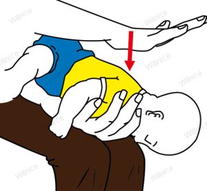 Give 5 back blows to relieve infant choking