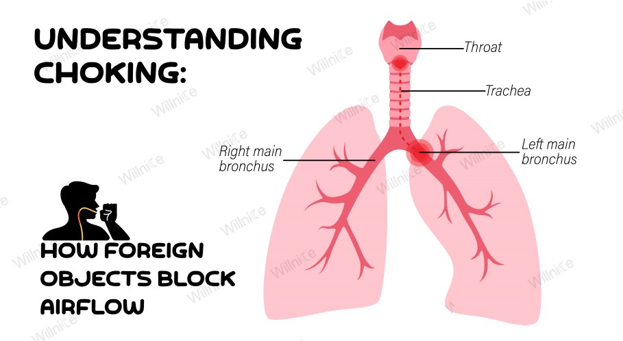 How Choking Occurs: Illustration of Airway Obstruction