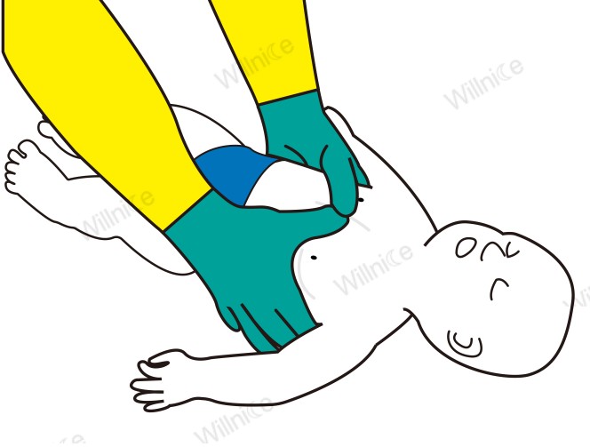 Infant CPR with both thumbs technique for 30 chest compressions