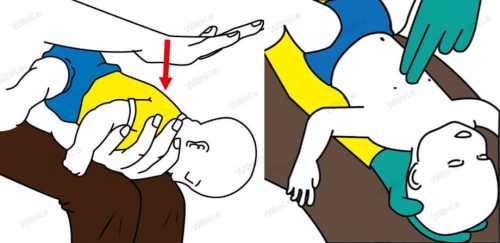 How to Safely Administer Back Blows to a Choking Infant