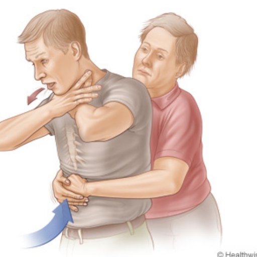 How to Perform the Heimlich Maneuver on Adults