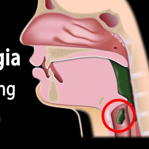 Understanding Dysphagia More Than Just Swallowing Issues