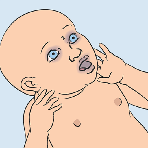 What Are the Signs and Symptoms of a Choking Child