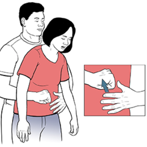 What Should You Do If Someone is Choking