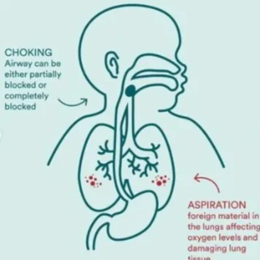 What is the Connection Between Aspiration Pneumonia and Choking