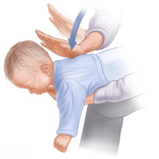 Perform Back Blows and Abdominal Thrusts on a Choking Infant