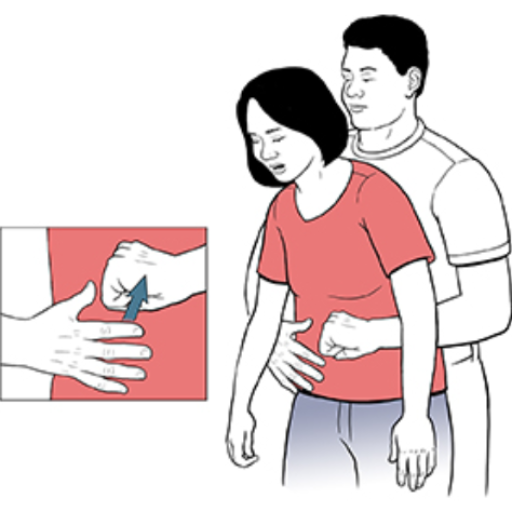 What to Do in Case of a Choking Incident?