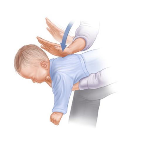 What Are the Signs a Baby is Choking?