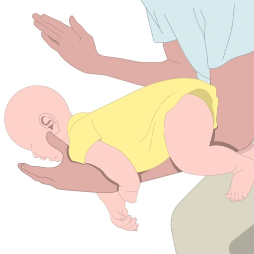 What are the first aid steps for a choking 1-year-old?