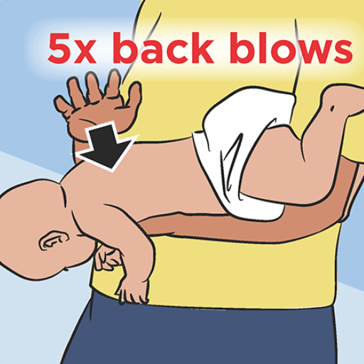 What should I do if back blows don't work?