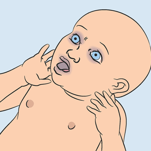 Immediate First Aid for a Choking Infant