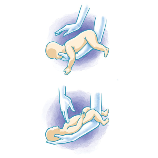 How to Recognize When a Choking Infant Needs Help