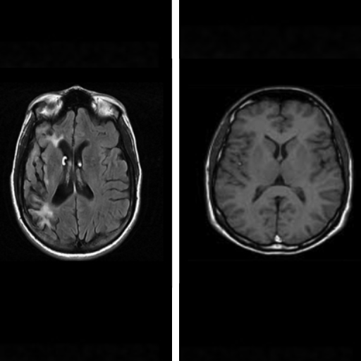 How can choking lead to an acquired brain injury (ABI)?