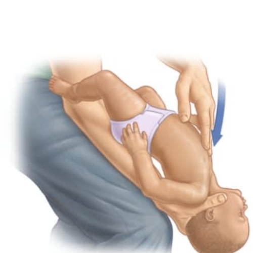 Choking First Aid: Essential Steps for Infant Choking Emergencies