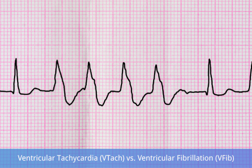 Ventricular Tachycardia (VTach) vs. Ventricular Fibrillation (VFib)