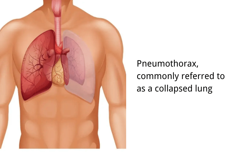 Pneumothorax, commonly referred to as a collapsed lung