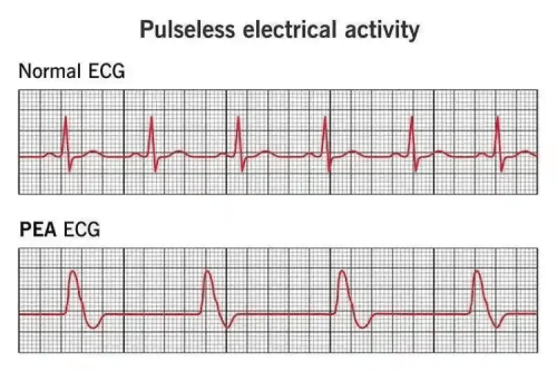 PEA: Pulseless Electrical Activity in Cardiac Arrest