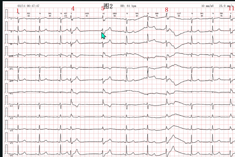 Ventricular parallel rhythm, sinus-ventricular fusion wave