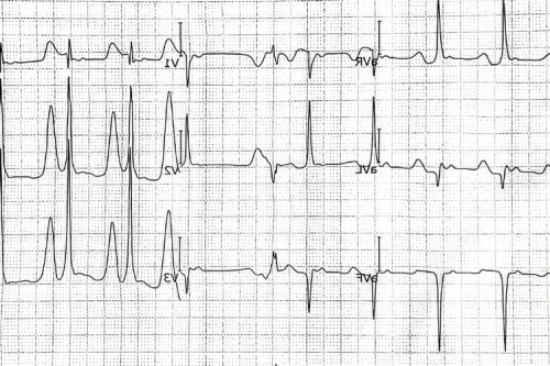 Ventricular Fibrillation: Causes, Symptoms & Treatment