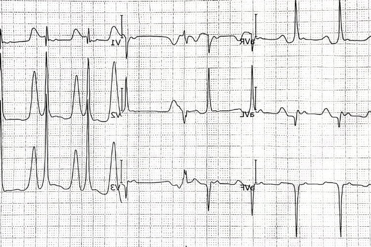 Ventricular Fibrillation: Causes, Symptoms & Treatment
