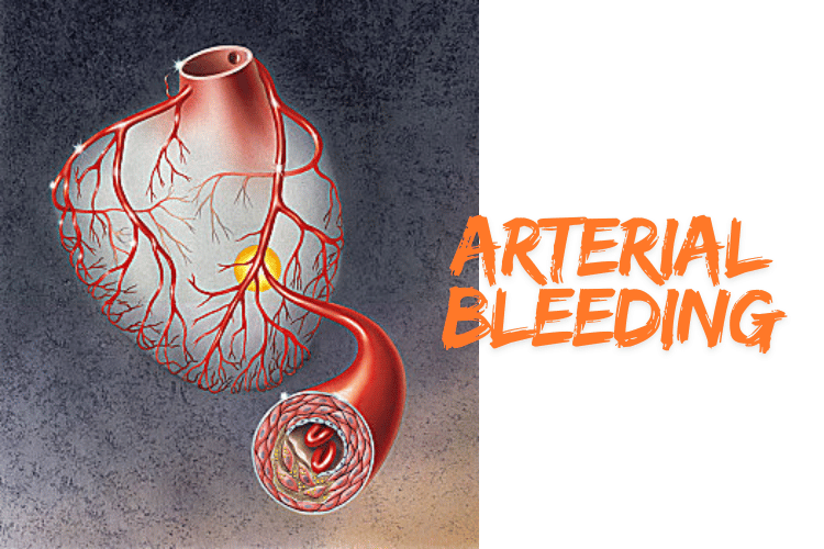 Arterial Bleeding