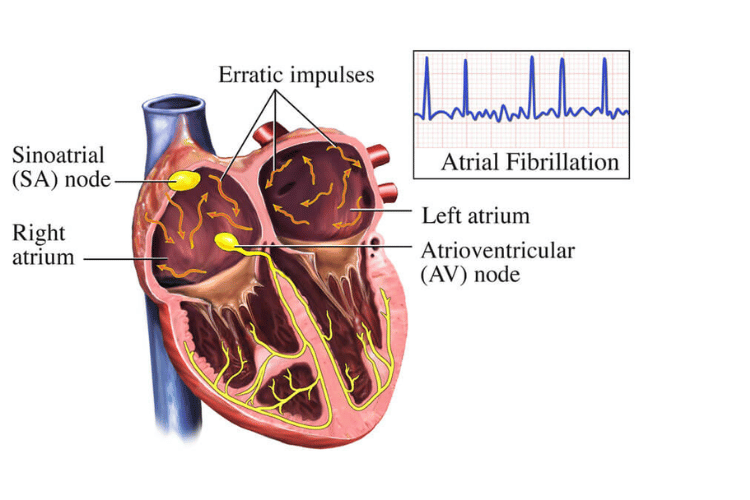 Atrial Fibrillation Overview