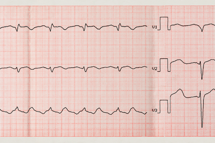 Atrial Fibrillation vs Ventricular Fibrillation: Key Differences