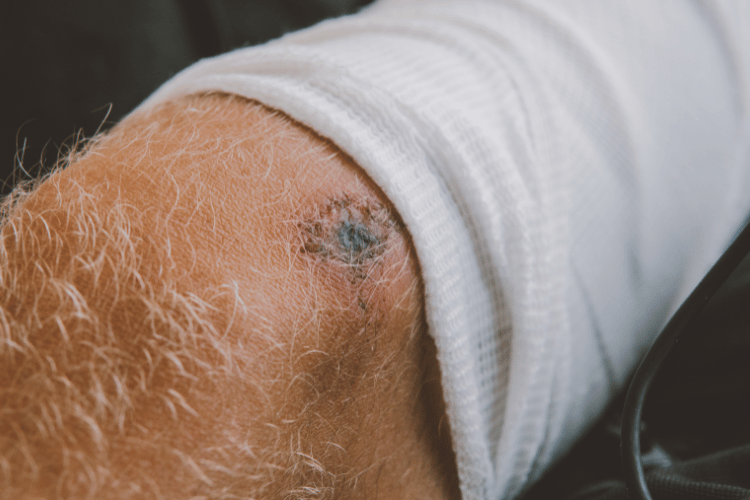 Contraindications and Considerations for Occlusive Dressings