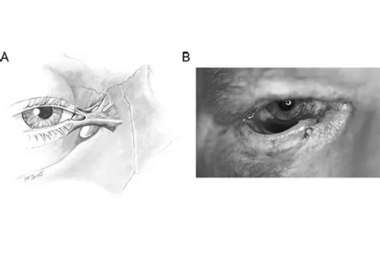 Eyelid Avulsion