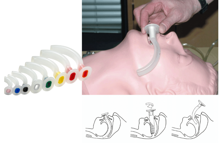 Management of the Airway in Semiconscious Patients
