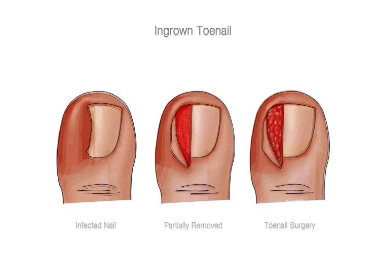 Nail Avulsion