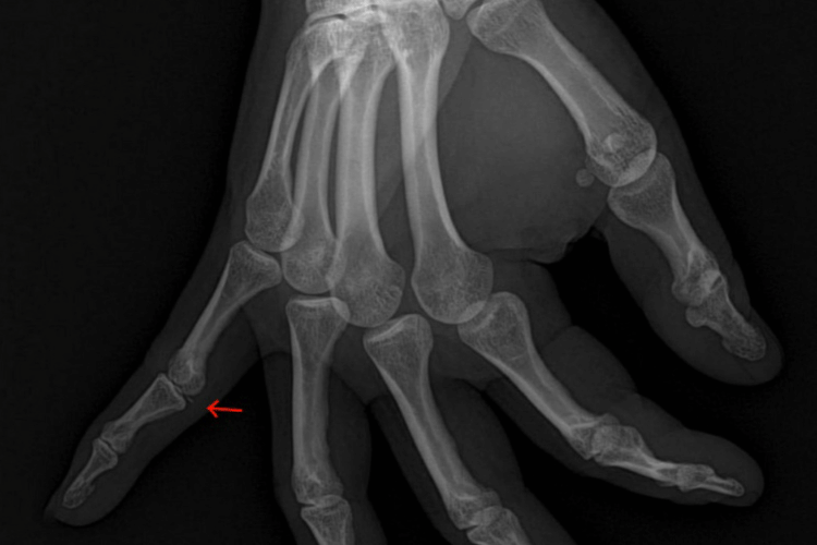 Periosteal Avulsion