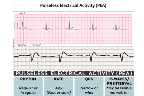 Pulseless Electrical Activity: Cardiac Arrest and Resuscitation