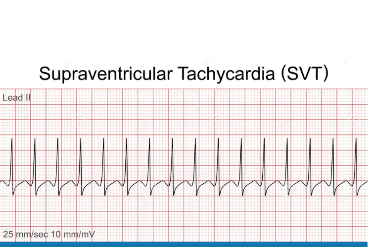Supraventricular Tachycardia (SVT)