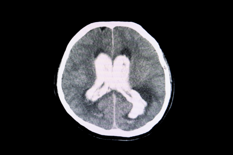 Symptoms of Intracranial Hemorrhage