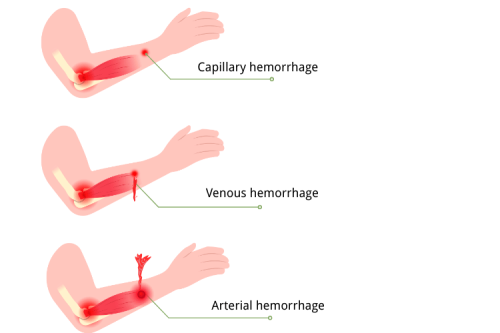 Venous vs Arterial Bleeding: Type of Bleeding & First Aid
