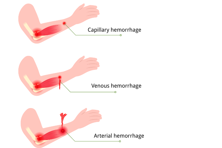Venous vs Arterial Bleeding: Type of Bleeding & First Aid