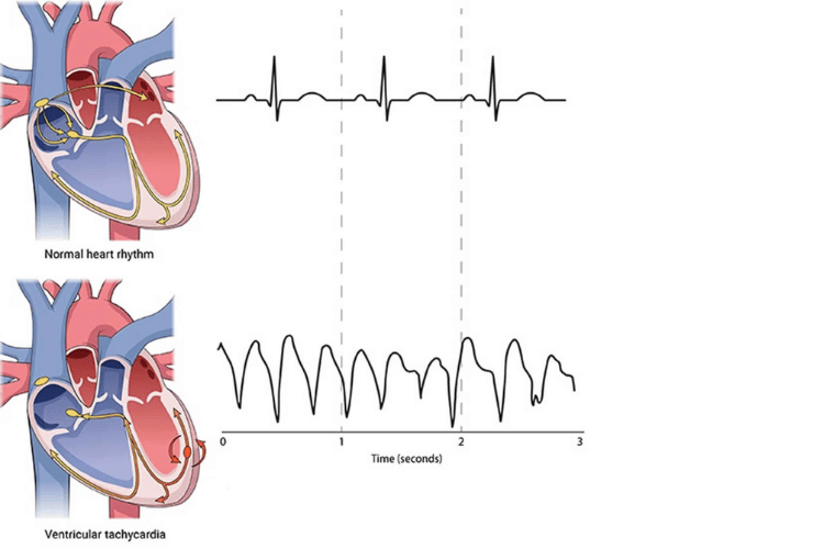 Ventricular Fibrillation