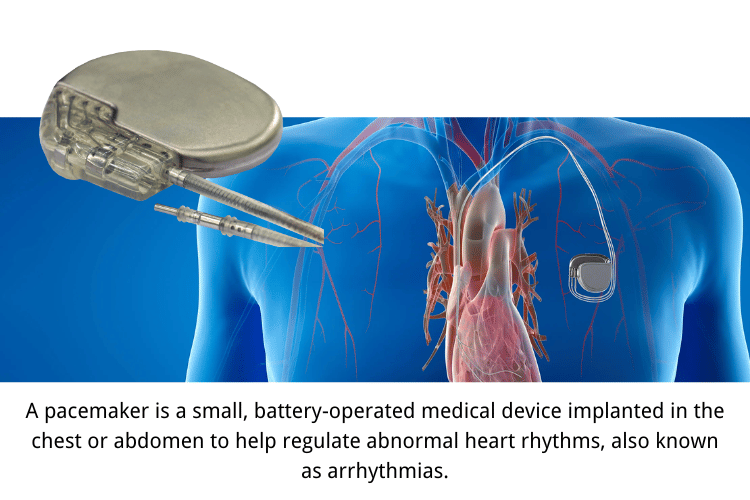 What is a Pacemaker?