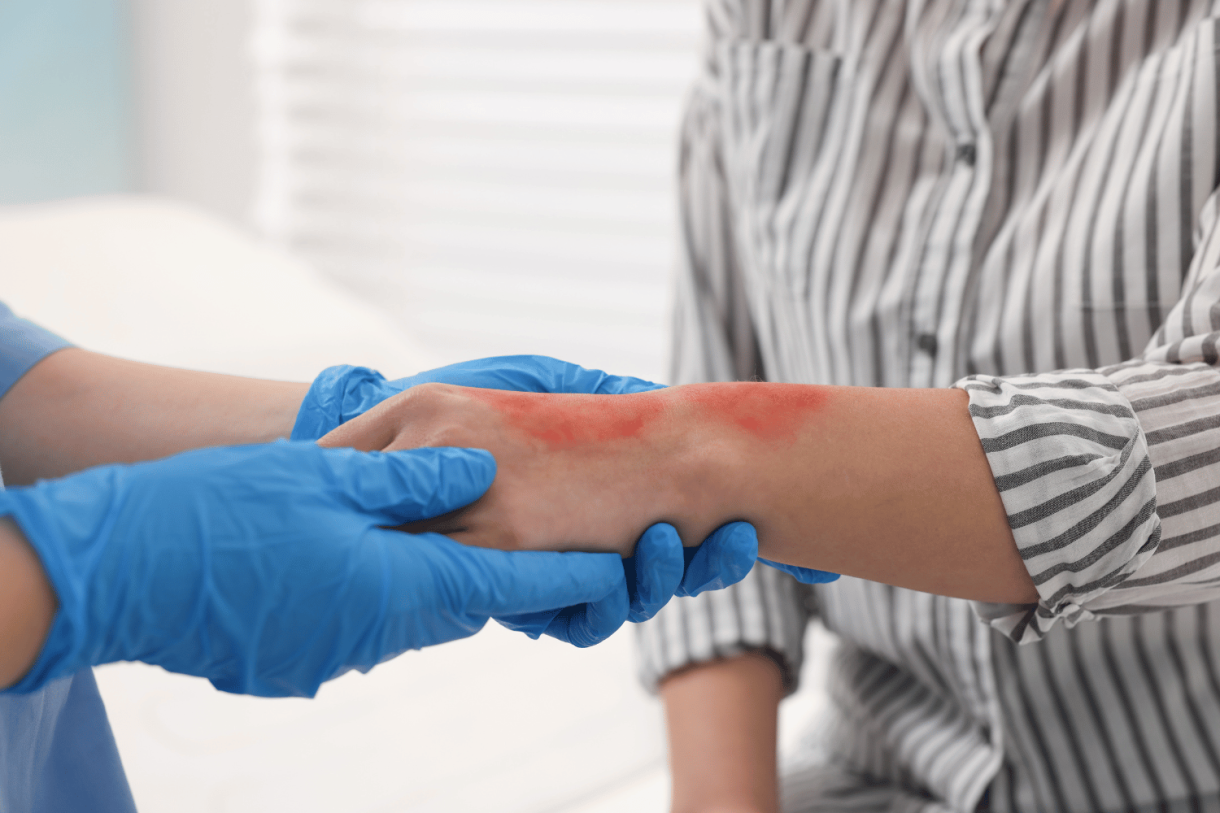 Burns: Causes, Symptoms, and First Aid Treatment