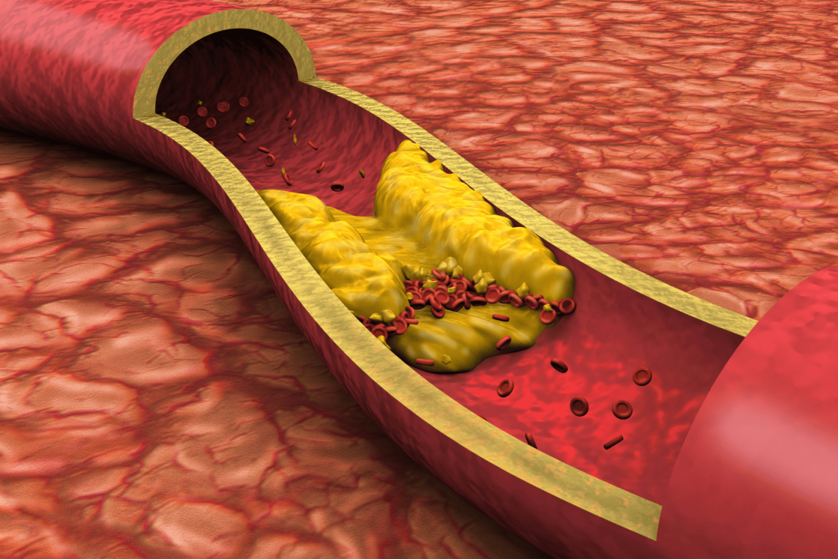 How High Cholesterol Levels Influence Heart Health